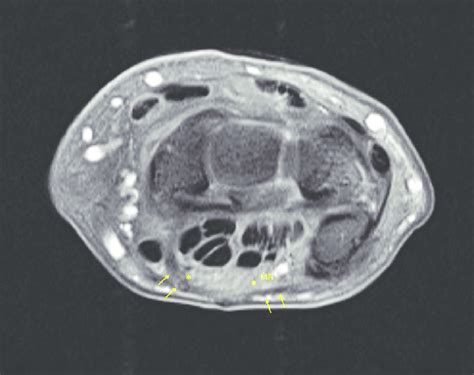 Right Wrist Magnetic Resonance Imaging Correlation In A Year Old