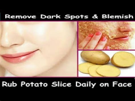 How To Use Potato On Face To Treat Skin Dark Spots Pimple Marks