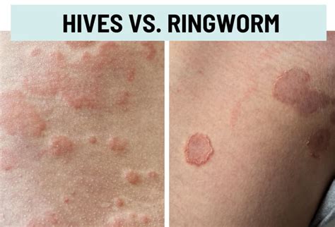 Hives Urticaria Vs Rash Pictures And Differences