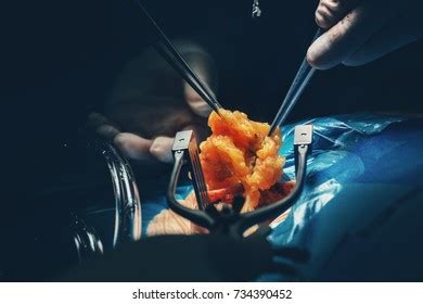 Cautery Royalty Free Photos And Stock Images Shutterstock