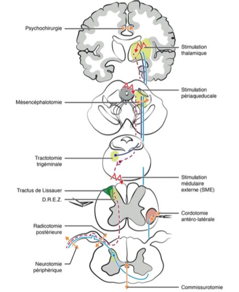 Anatomie De La Douleur Neurochirurgien Marseille Aix En Provence