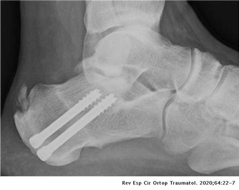Medial Calcaneal Osteotomy