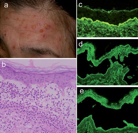 A Case Of Subepidermal Blistering Disease With Autoantibodies To Multiple Laminin Subunits Who