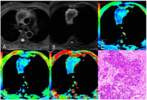 A Representative Case Of Thymic Squamous Cell Carcinoma A Axial