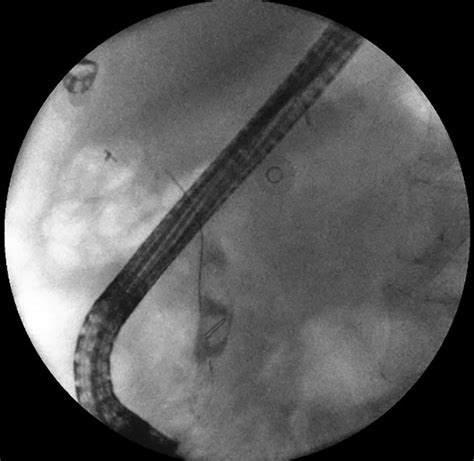 Ercp Cholangiogram Of The Same Patient Showing A Bile Duct Stone Formed Download Scientific