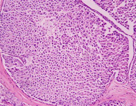 Lobular carcinoma in situ / Atypical Lobular Hyperplasia — EZ-Path