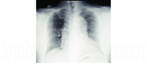 Chest X Ray Of A Patient With Atad Showing A Widened Mediastinum Download Scientific Diagram