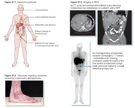 Neuroendocrine Tumours Pediagenosis
