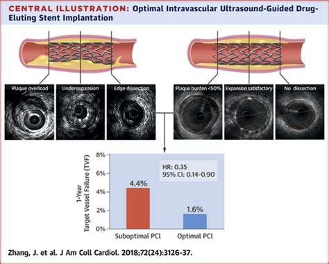 Intravascular Ultrasound Versus Angiography Guided Drug Eluting Stent