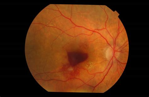 Degeneraci N Macular Asociada A La Edad Dmae Unidad Macula