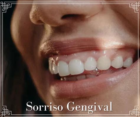 O que é o Sorriso Gengival Ortocoi Clínica Ortodôntica