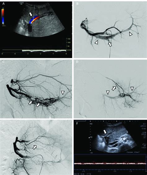 Endovascular Approach Iatrogenic Post Biopsy Type 1 Arterioportal