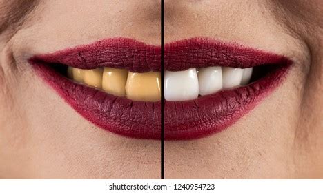 Tooth Whitening Before After Stock Photo 1240954723 | Shutterstock