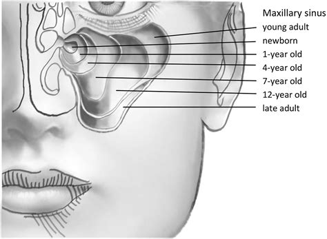 Pediatric Paranasal Sinuses—development Growth Pathology