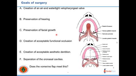 The Use of Vomer Flap in Palatal Surgery | Prof. Sunday O Ajike | 24 ...