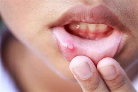 Aphte langue bouche gencive lèvre comment le soigner