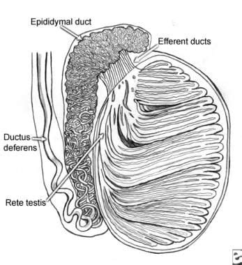 Testicular Spermatocele