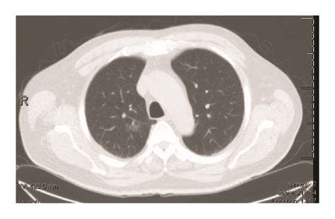 Ct Scan Showing A 1 9 × 1 1 Cm Right Upper Lobe Lung Mass Download Scientific Diagram