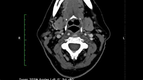 CTA Head And Neck Stroke YouTube