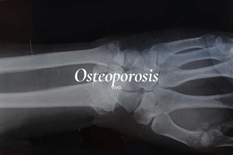 Osteoporosis