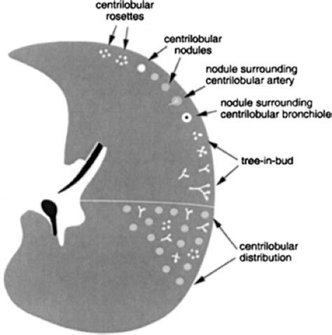 Diffuse Lung Disease Thoracic Key