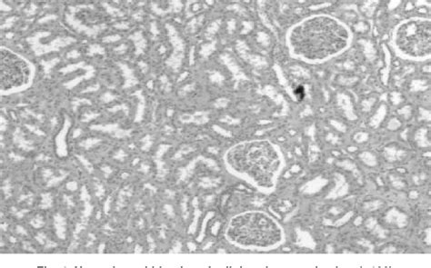 Figure 4 From A Study Of Frequency Of Glomerular Diseases Biopsy