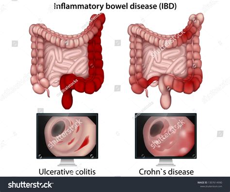 20,868 Bowel Disease Images, Stock Photos & Vectors | Shutterstock