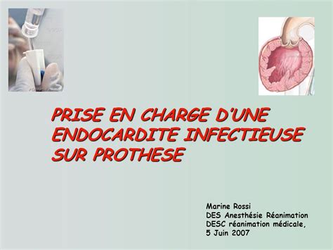 Prise En Charge D’une Endocardite Infectieuse Sur Prothese Pdf Etude Az