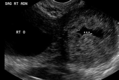 Ultrasound In Ectopic Pregnancy