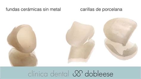 Carillas o Fundas Qué es mejor y qué diferencia hay Dobleese