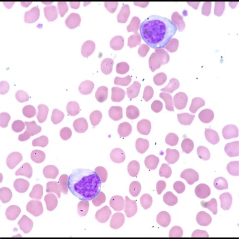 Mononucleosis - Acute Infectious Mononucleosis Pathogenesis And ...