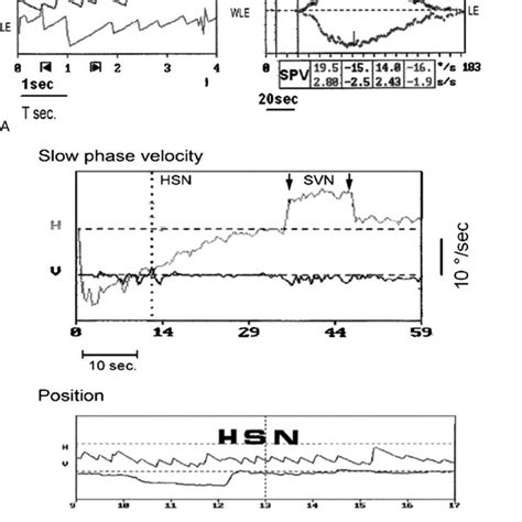 Pdf High Frequency Skull Vibration Induced Nystagmus Test In Partial Vestibular Lesions