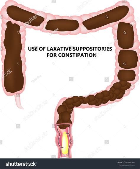 Bristol Stool Chart With Excrement Description And Types Outline