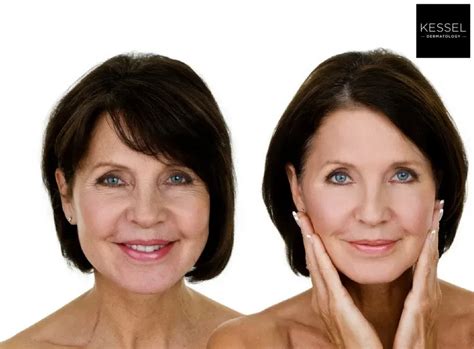 What Is The Difference Between Dysport And Botox Board Certified