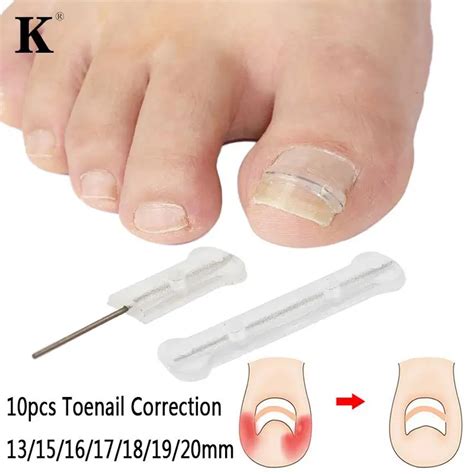 Pc Box Ingrown Toenail Correction Tool Ingrown Toe Nail Treatment