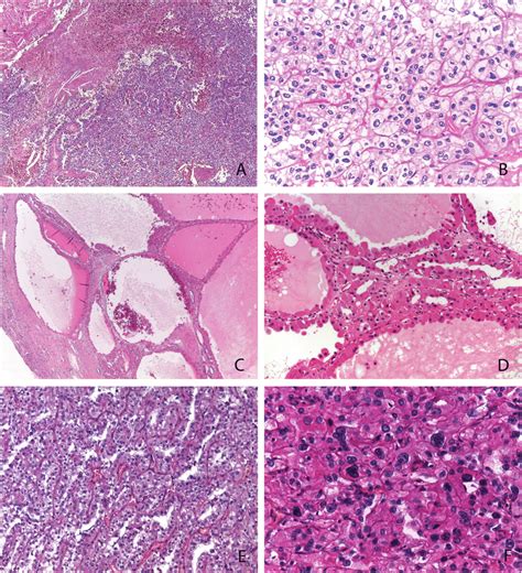 Histologic Features Of Tfeb Amplified Renal Cell Carcinomas Low Power