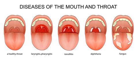 Chronic Pharyngitis: Symptoms, Causes, Home Remedies | STD.GOV Blog