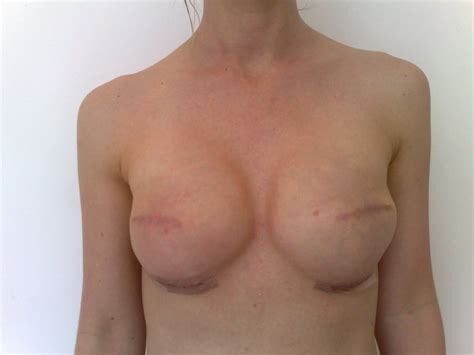 Naked Breasts Cancer Photos