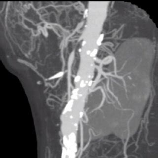 Angiotomografia De Aorta Abdominal E Ramos Oclus O Do Tronco