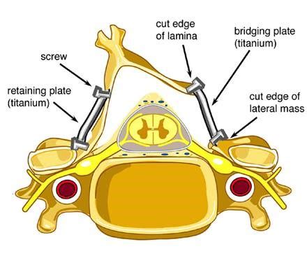 Cervical Laminoplasty Samuel K Cho Md