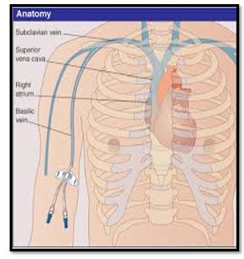 Picc Catheter