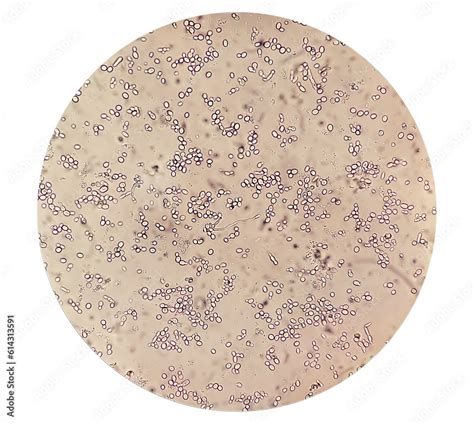 Budding Yeast Cells In Patient Urine Urinary Tract Infections Pyelonephritis Or Cystitis