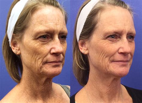 Under Eye Fraxel Laser Before And After Thebrokensealblog