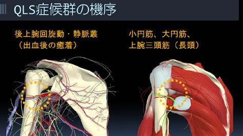 肩関節疾患の病態を理解した評価と運動療法2 腱板断裂術後人工肩関節術後結帯動作障害手技紹介を中心に