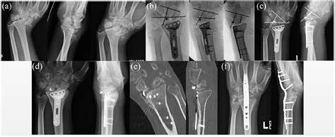 Avascular Necrosis Of The Lunate Secondary To Perilunate Fracture