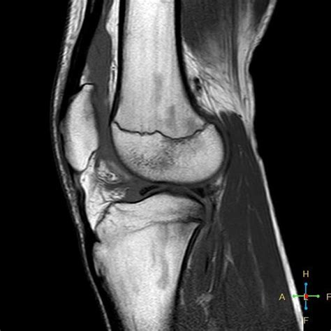 Anterior Cruciate Ligament Mri