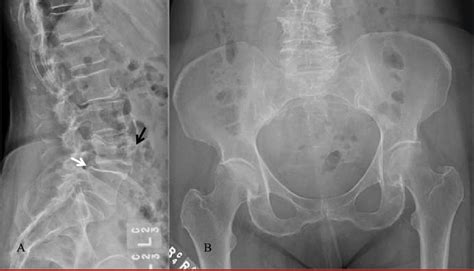 A A Lateral Radiograph Of The Lumbar Spine Revealing A Superior