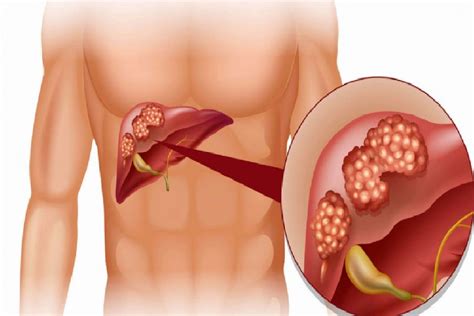 Karaciğer kanserinin belirtileri nelerdir Karaciğer kanser tedavisi