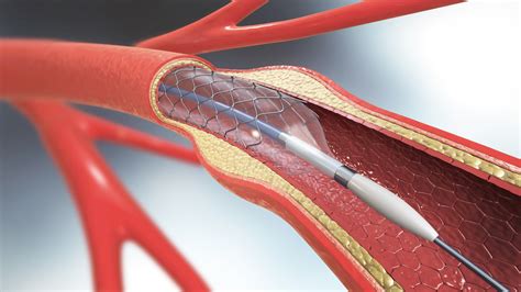 Heres What You Need To Know About Carotid Angioplasty And Stenting