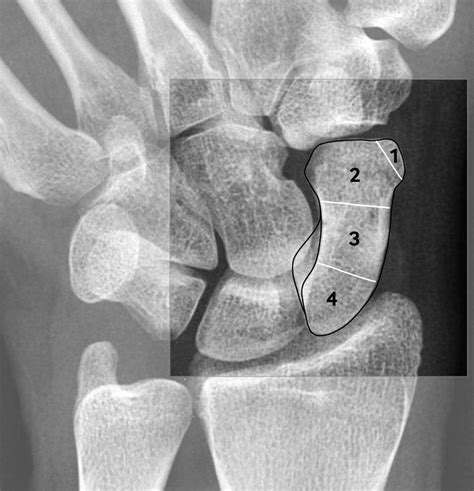 Scaphoid Tubercle